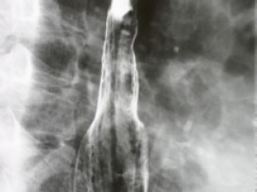 Postoperative barium swallow test (4 years after surgery)