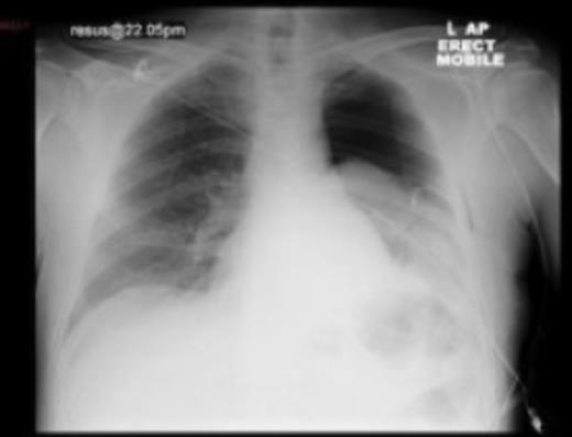 CXR post-thoracostomy