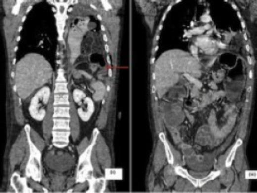 CT scan coronal images depicting the diaphragmatic defect (arrow) with herniation of mesentery and bowel into the left hemithorax (i) and large bowel dilatation proximal to the defect (ii)