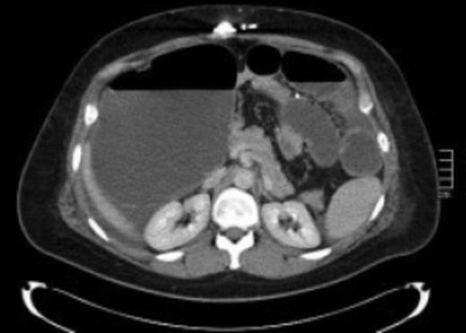 Axial Computed Tomography scan of abdomen demonstrating distended bowel