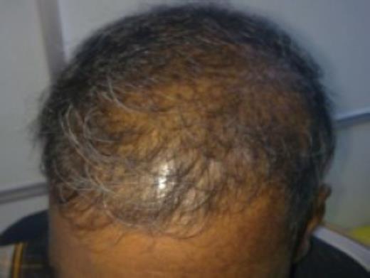 Alopecia