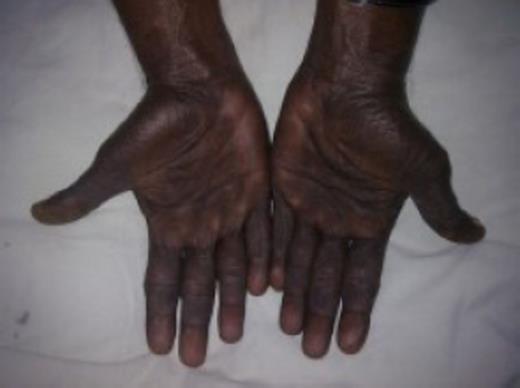 Diffuse skin hyperpigmentation involving the palms