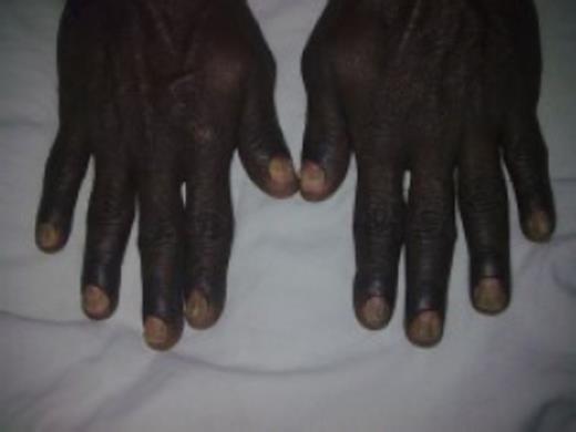 Onychodystrophy of finger nails
