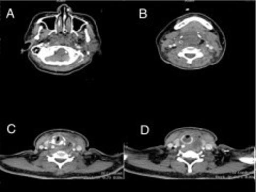 Serial contrast enhanced axial CT images at (A) the level of the nasopharynx show complete occlusion of the air passage, (B, C, D-blue arrows) the level of the oropharynx and hypopharynx with ill defined rim enhancing cavities and air pockets on the left and around the right carotid sheath