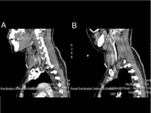 Serial contrast enhanced sagittal images shows a cluster of air within the abscess cavity immediately subhyoid and linear air posterior to the right carotid sheath