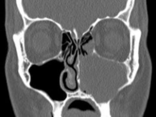 Computed tomography of the patient preoperatively