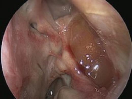 Intraoperative image of recurrence along the maxillary antrum