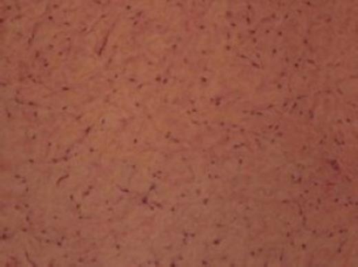 Microphotograph of the biopsy specimen from the mass showing characteristic spindle cells amid the myxoid stroma, consistent with the diagnosis of myxoma