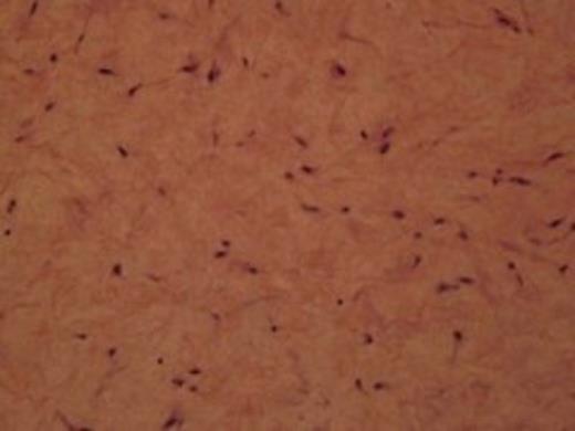 Histologic appearance of the specimen indicative of mitotic features in a loose and myxomatous stroma