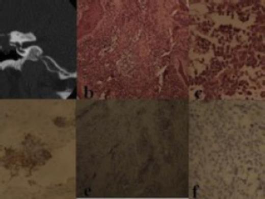 a) CT scan showing mass in the middle ear; b) Photomicrograph showing tumor tissue surrounded by stratified squamous epithelium and admixed with fibrous stroma (H & E, X 100); c) Photomicrograph shows discohesive, round to oval neoplastic cells with scant cytoplasm and hyperchromatic nuclei (H & E, X 400); d) Photomicrograph showing immunopositivity of neoplastic cells for desmin (X 400); e) Photomicrograph shows immunonegativity for CD20 (X 100); f) photomicrograph shows cells also negative for CD3 (X 400)