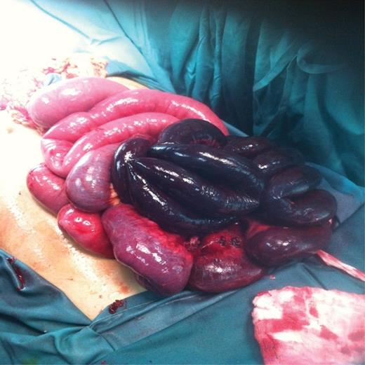 Gangrenous ileum found on emergency exploratory laparotomy.