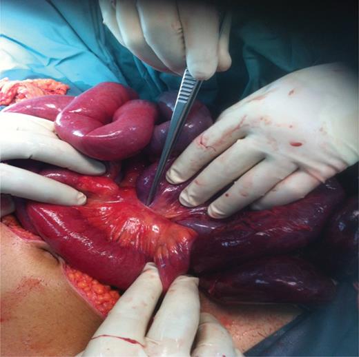 Ileum herniated through congenital mesenteric defect.