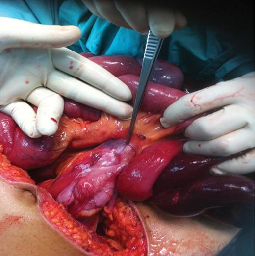 Herniation caused gangrenous terminal ileum.
