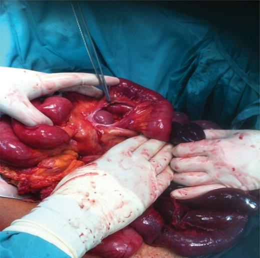 Congenital mesenteric defect at mid-jejunum.