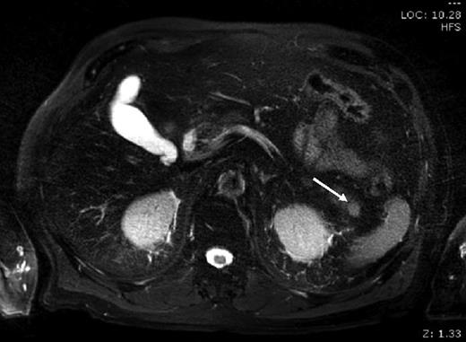 MRI: small round lesion in the pancreatic tail measuring 1×1 cm, enhancing homogenously in the portal venous post-contrast phase suggesting a solid neoplastic lesion. The differential includes primary pancreatic lesion such as a small mucinous cystic pancreatic tumour or an islet cell tumour