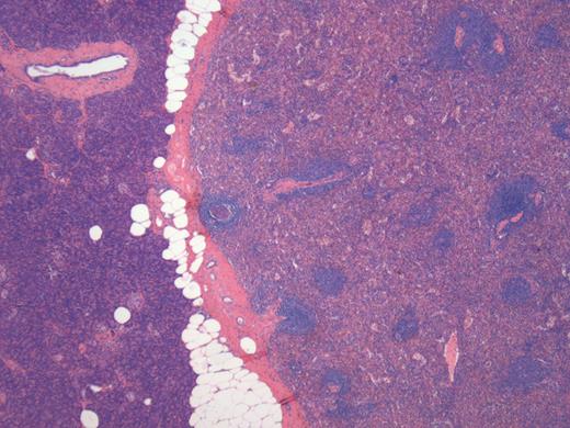 Histology of the lesion showing the normal pancreas on the left with the accessory spleen on the right