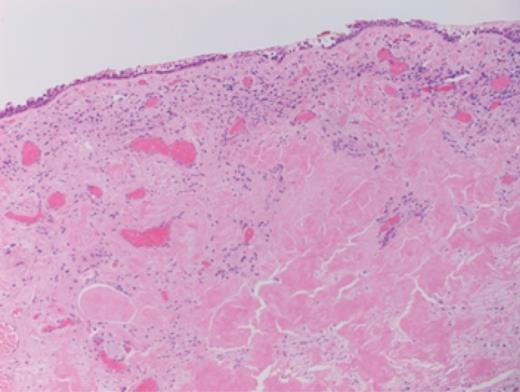 Aggregates of acellular eosinophic material.