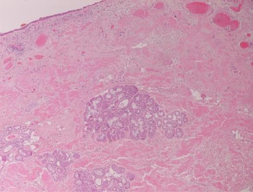 Amyloid deposits.