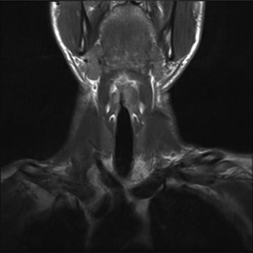 Coronal view, T1 weighted MRI neck showing abnormal low intensity foci in the left false vocal cord.