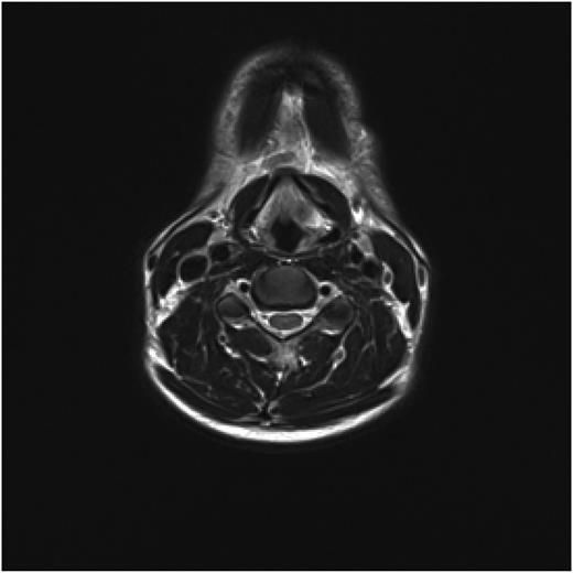 Axial view of MRI neck demonstrating soft tissue abnormality in the left supraglottic area.