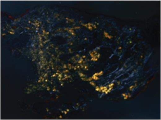 Congo red staining of the biopsy sample. Histology shows an acellular, amorphous, eosinophilic material deposit in the stroma, with perivascular and periglandular accentuation. Typing of the specimen is based on clinical and laboratory findings (including paraproteinaemia looking for an underlying myeloma, TTR gene rearrangement studies looking for the genetic defect in familial amyloid.)