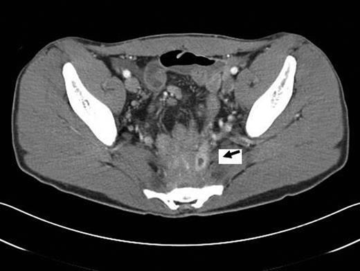 CT scan. Presacral air-fluid collection with a pouch-sacral fistula (arrow).