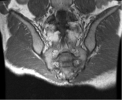 MRI (coronal view). Osteomyelitis of segments S2–S4.