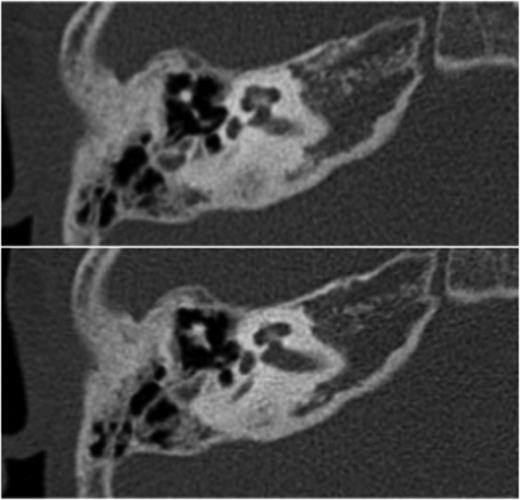 Transverse high-resolution CT demonstrates intact ossicles with malposition of the stapes