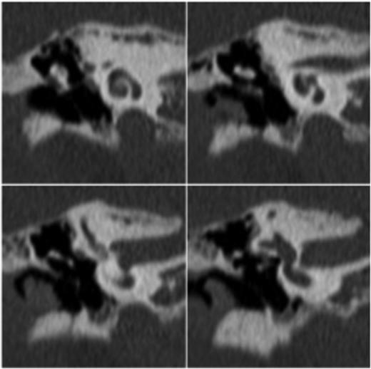 Reformatted coronal images of the middle ear