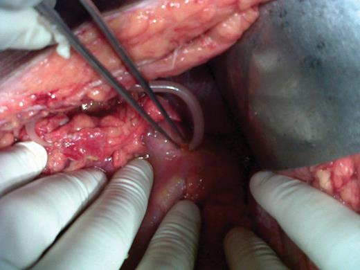Ascaris protruding through gastric perforation