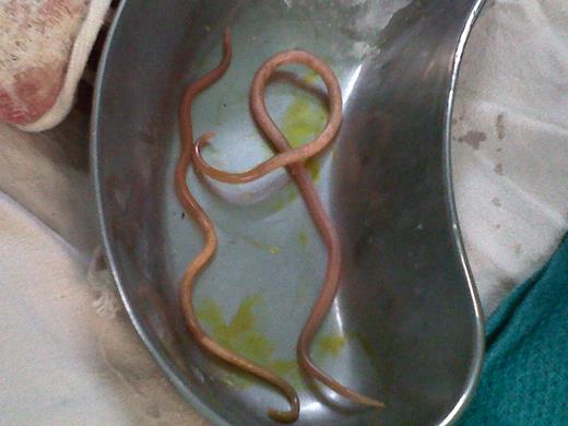 The two extracted Ascaris lumbricoides