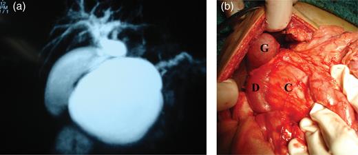 (a) MRCP with 2D-reconstruction demonstrating features indicating a type 1 choledochal cyst, (b) intra-operative showing gallbladder (G), duodenum (D) stretched and compressed with widened C loop of duodenum and the pseudocyst (C) within.
