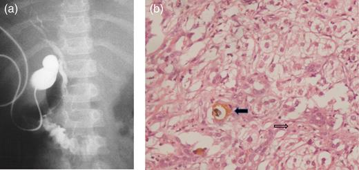 (a) Post-operative cholecysto-cholangiogram demonstrating passage of contrast across the biliary tree into the duodenum. (b) Bile duct proliferation (thin arrow) and bile plug (bold arrow) (H&E, ×20).