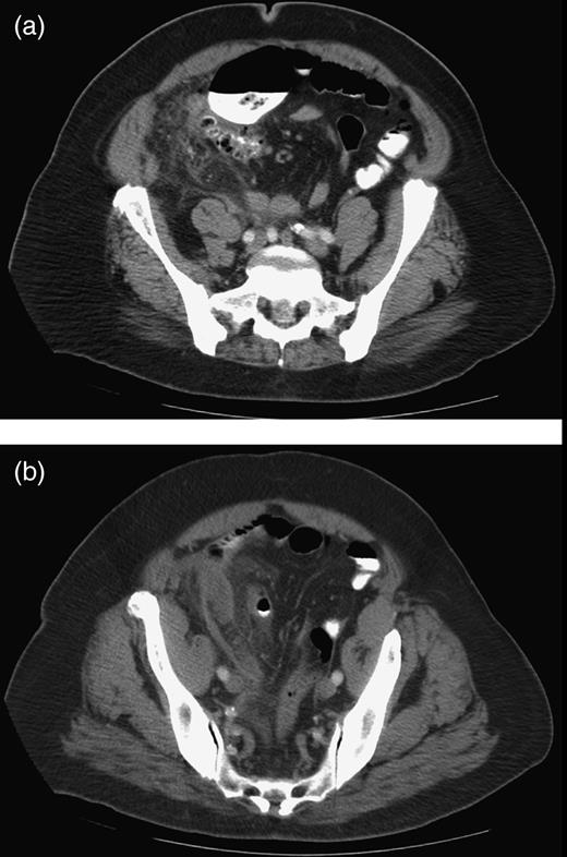(a and b) Axial CT scan demonstrating infiltrative changes in the pericolonic fat and a small amount of free fluid in the right pelvis.
