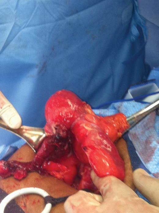 Intraoperative findings demonstrating a large mass at the ileocecal junction involving the appendix.