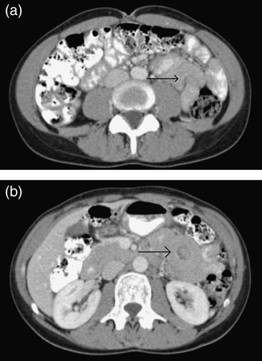 (a) The CT scan of the abdomen demonstrating an area of small bowel intussusception (arrow) resulting in a mushroom sign. (b) The CT scan of the abdomen demonstrating an area of small bowel intussusception (arrow) resulting in a target sign.
