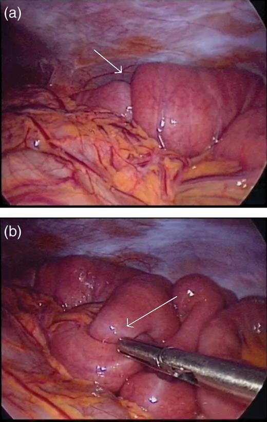 (a) Short segment of small bowel intussusception (arrow) that reduced spontaneously during laparoscopy. (b) A separate segment of small bowel intermittently intussuscepting and reducing (arrow) during laparoscopy.
