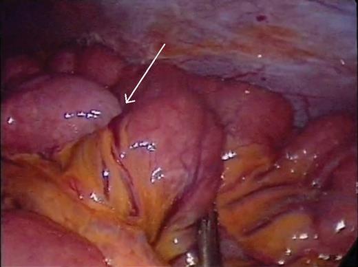 Small bowel intussusception (arrow) that did not reduce spontaneously.