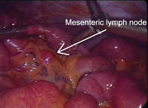 Prominent mesenteric lymph nodes (arrow) discovered during laparoscopy.
