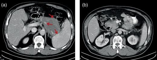 Preoperative CT scans. (a) The pancreatic mass in the tale of the pancreas, the arrows shows the relationship to the colon, to the spleen and to the splenic artery and (b) the pancreatic mass in the head of the pancreas.