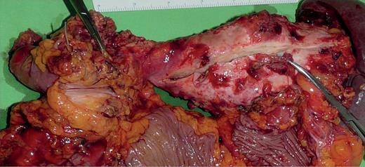 Macroscopic specimen (two separate pancreatic mass in the head and in the tale of the pancreas + duodenum + colon + spleen).