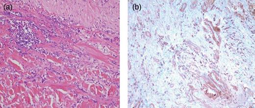 Histopathologic examination of the pancreatic mass: (a) HE and (b) IgG4 immunohistochemistry.