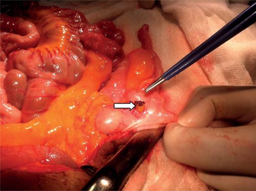 Abnormal vessels on the caecum.