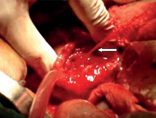 Arterial blood spurting from the major duodenal papilla.