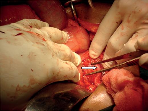 Aberrant vessel on the pancreatic head.
