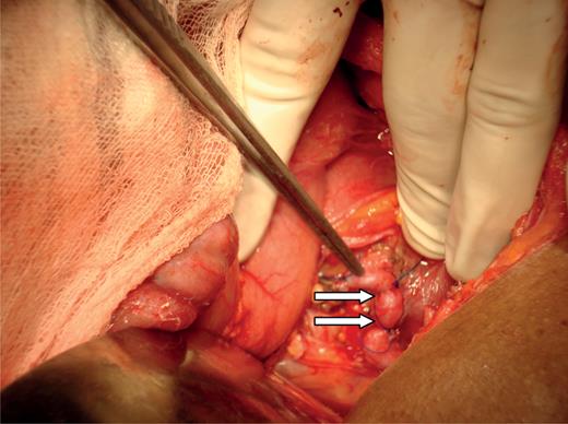 Aberrant vessel on the pancreatic head being tied.