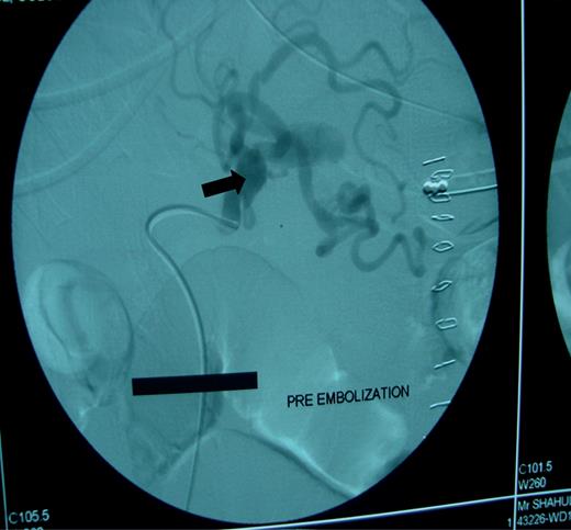 Coeliac angiogram showed aberrant vessel arising from celiac trunk.