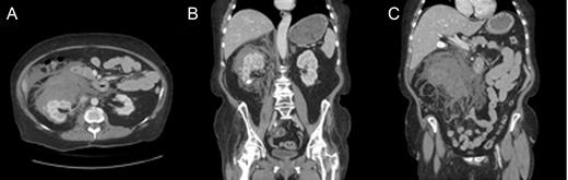 Peri- and paranephric hematoma filling the right retroperitoneum. Pre-contrast and contrast enhanced abdominal and pelvic CT with (A) axial, and (B and C) coronal views. The hematoma distends the renal fascia, crosses the midline and displaces other peritoneal and retroperitoneal structures. Free fluid, and a hyperdense focus of vascular contrast is present adjacent to the hematoma (best seen in A). An incidental ∼18 mm right lower pole renal calcification (B). The estimated size of the hematoma was 13 × 12 × 8.5 cm. Incidental finding of cholelithiasis (C)
