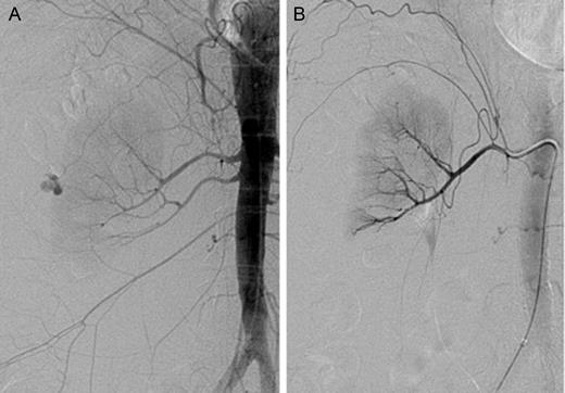 Identification and subsequent embolization of an active extravasation from the superior right renal artery. (A) Renal angiogram of the right kidney prior to embolization. Both a superior and an inferior right renal arteries are present. There is an active extravasation of blood from the subsegmental branch of the superior right renal artery. (B) Post-embolization renal angiogram. There is no definitive focus of active extravasation