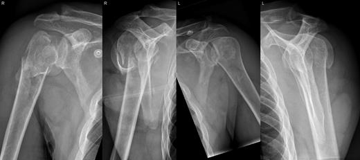 Bilateral posterior fracture dislocation.